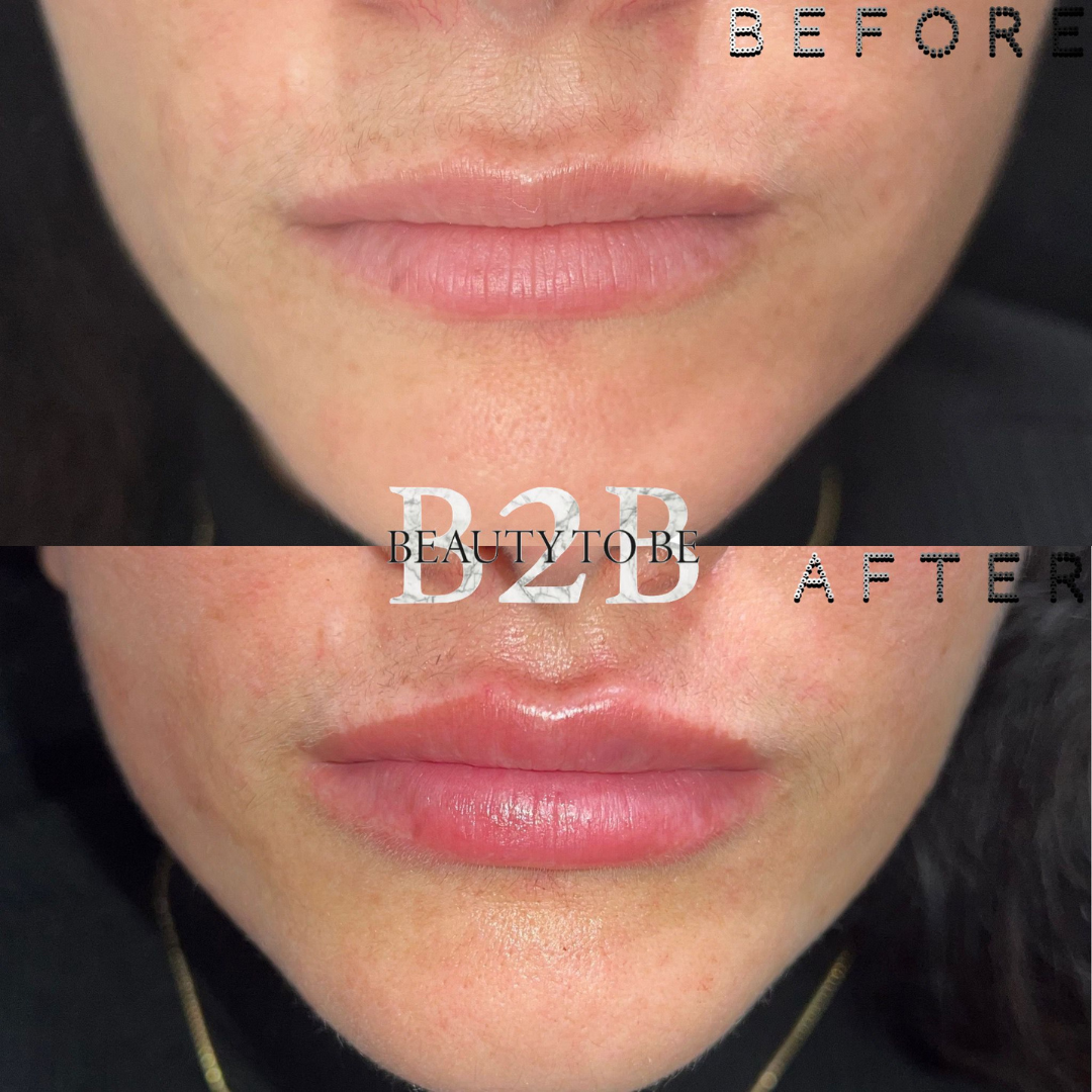 Skinbooster resultaat